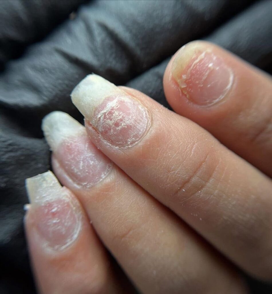 Móng hư tổn do nhiều tác nhân bên ngoài